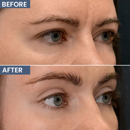 LIMETOW® Lid Lifting Treatment