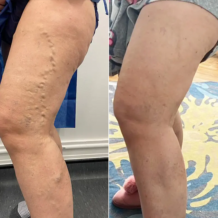 LIMETOW® Leg Relief Cream