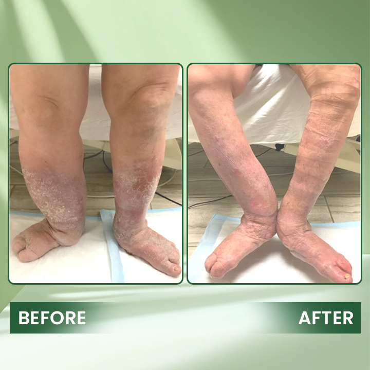 LIMETOW® Edema Relief Lotion