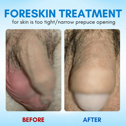 Foreskin Elasticity Gel：Restore Foreskin Elasticity — Pain-Free Tightness Relief! ⚡