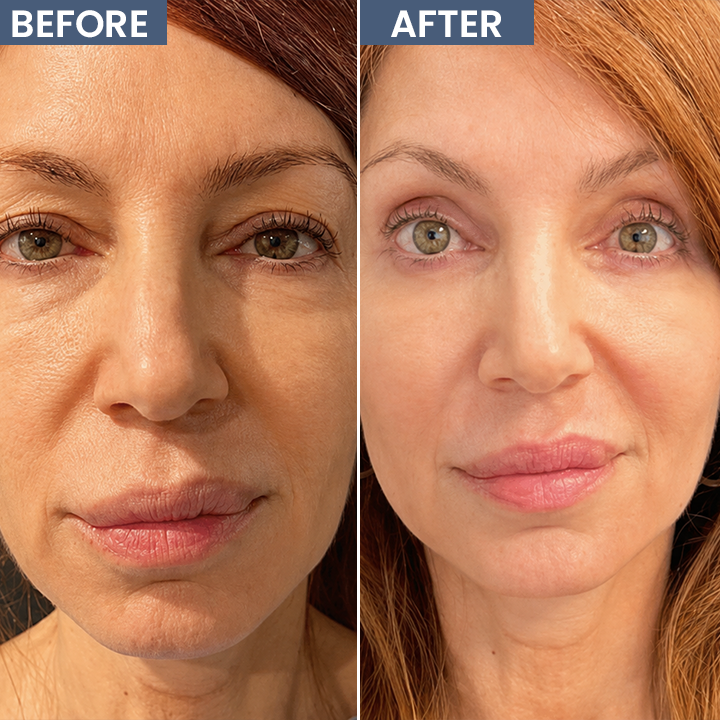 LIMETOW® Lid Lifting Treatment
