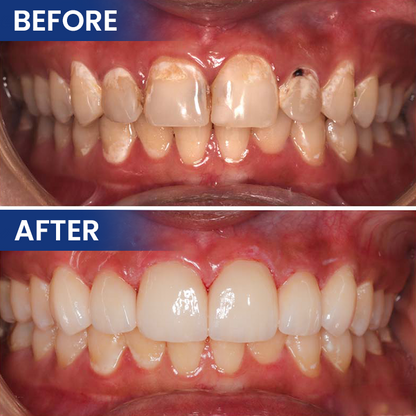 LIMETOW® Bee Venom Oral Care Solution