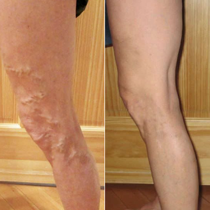 LIMETOW® Leg Relief Cream