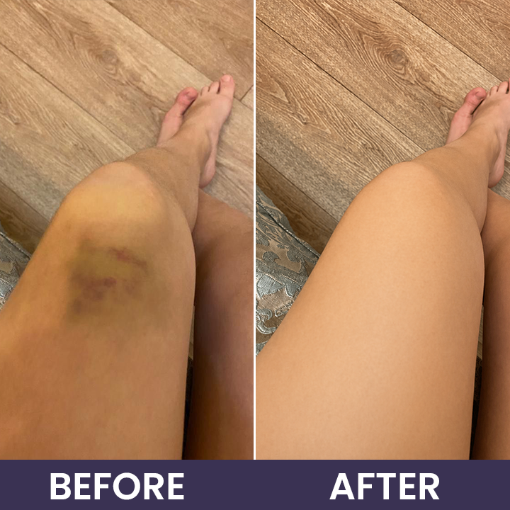LIMETOW® Bruise Repair & Skin-Strengthening Cream