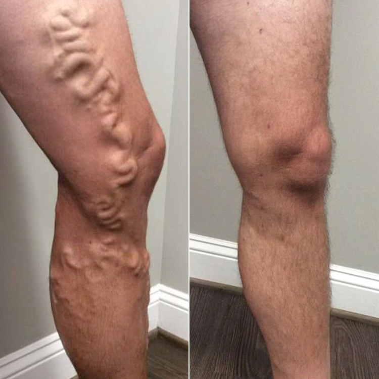 LIMETOW® Leg Relief Cream