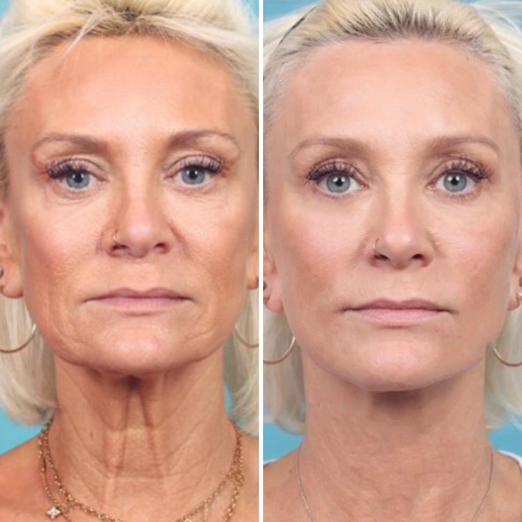 LIMETOW® Bee Venom Firming & Anti-Wrinkle Cream