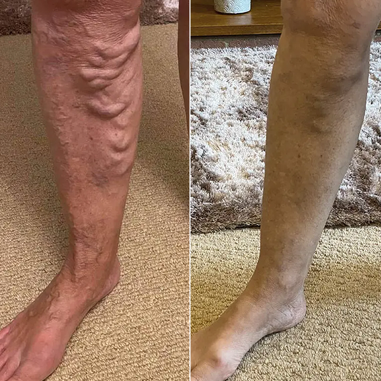 LIMETOW® Leg Relief Cream