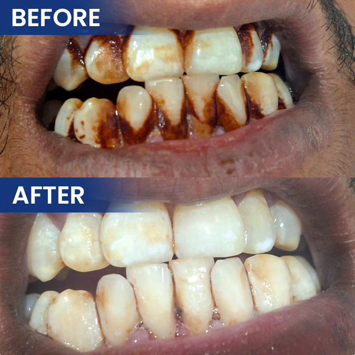 LIMETOW® Bee Venom Oral Care Solution