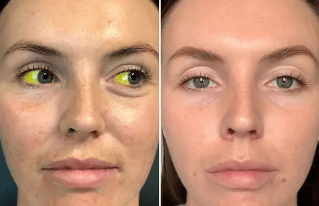 BalanceVie OptiClear Nano Eye Roller Serum