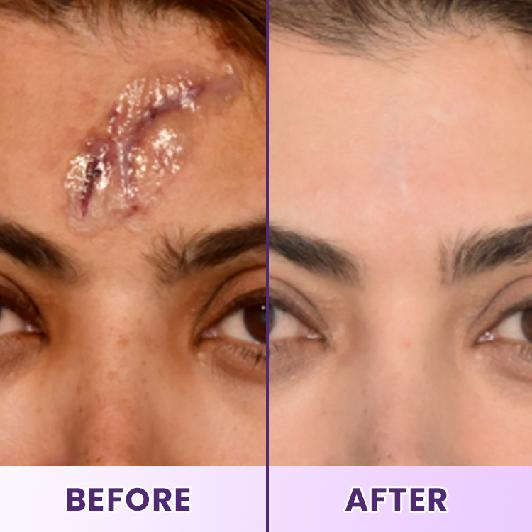 LIMETOW® ReGenScar Stem Cell Scar Gel