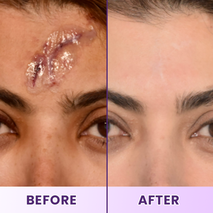 LIMETOW® ReGenScar Stem Cell Scar Gel