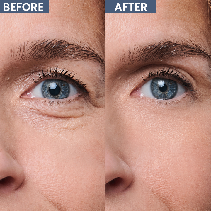 LIMETOW® Lid Lifting Treatment