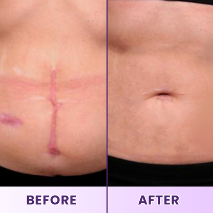 LIMETOW® ReGenScar Stem Cell Scar Gel