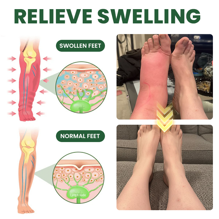 LIMETOW® Edema Relief Lotion