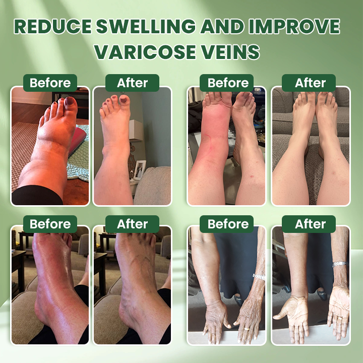 LIMETOW® Edema Relief Lotion