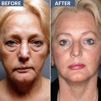 LIMETOW® Lid Lifting Treatment