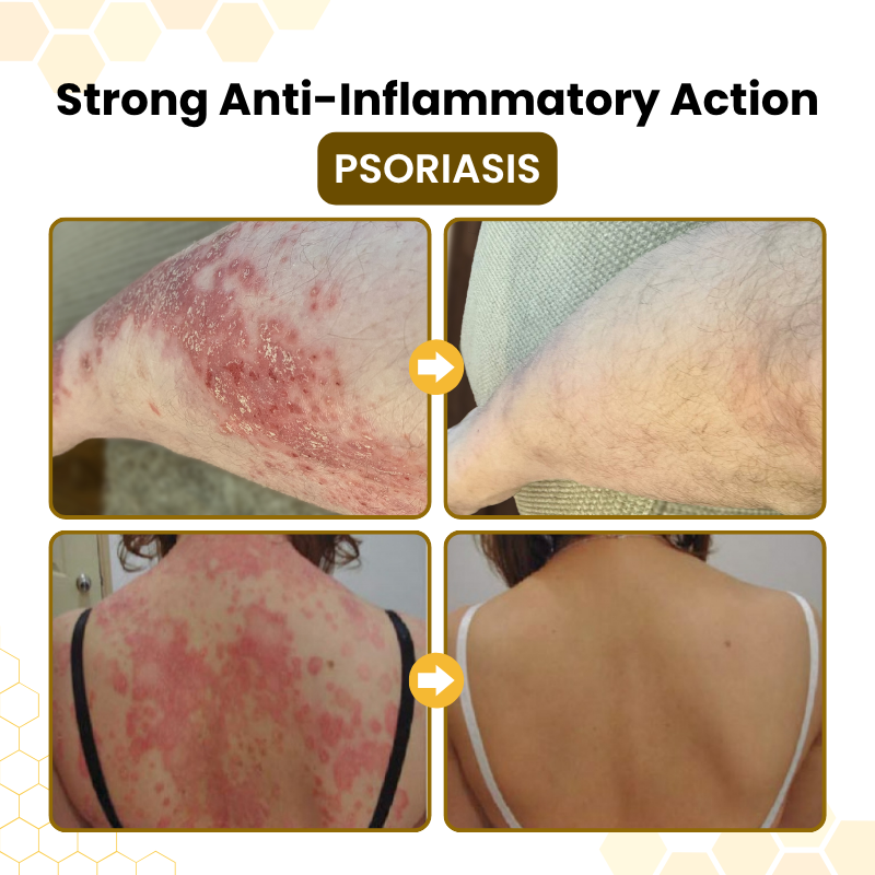 LIMETOW® PsoriaSoothe Skin Care Cream