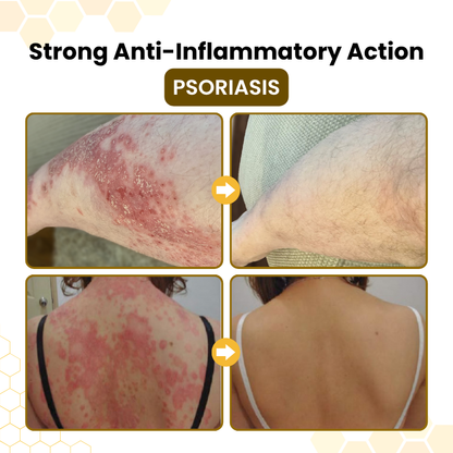 LIMETOW® PsoriaSoothe Skin Care Cream