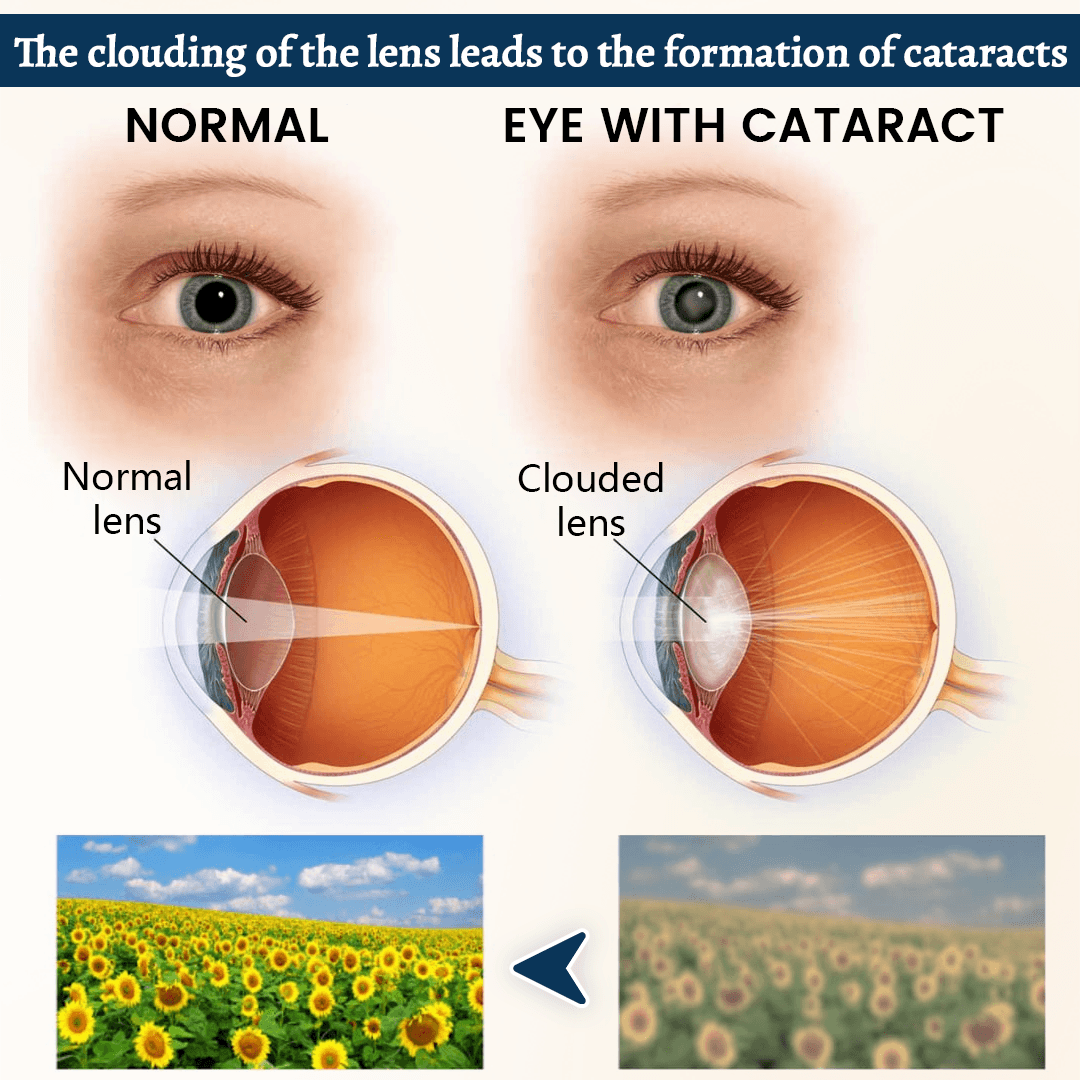 Relieflogix OptiFusion Vision Support Eye Patch
