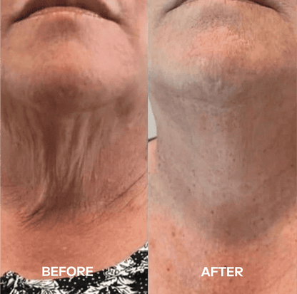 Dealing With Wrinkles, Sagging Skin, or Lines on Your Neck? Get a Visibly Younger-Looking Neck in Just 3 Hours!