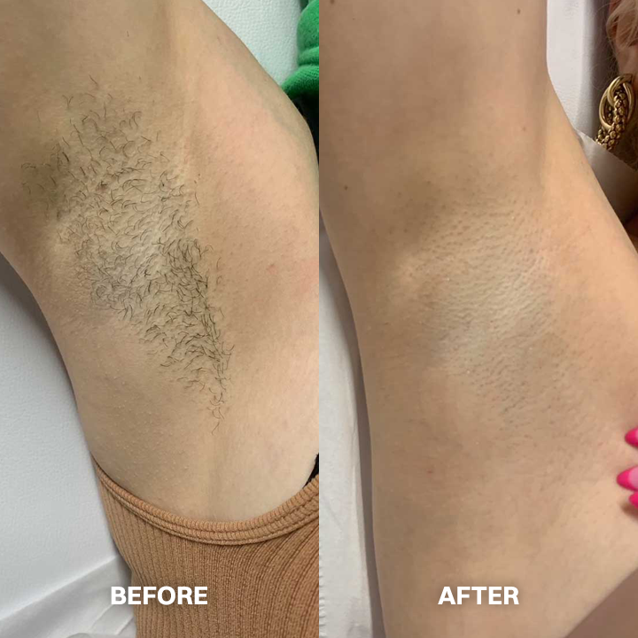 LIMETOW® Hair Removal Cream for All Women & Men