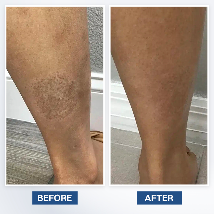 LIMETOW® Scar Removal Cream
