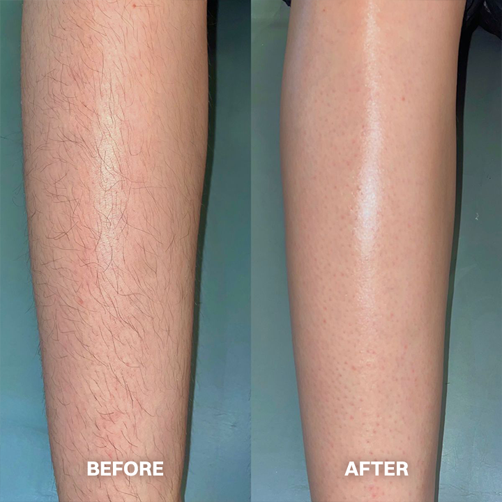 LIMETOW® Hair Removal Cream for All Women & Men