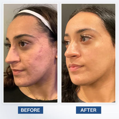 LIMETOW® Scar Removal Cream