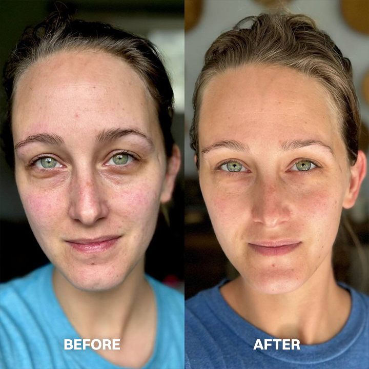 LIMETOW® Scar Removal Cream