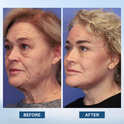 LIMETOW® Facelift Serum
