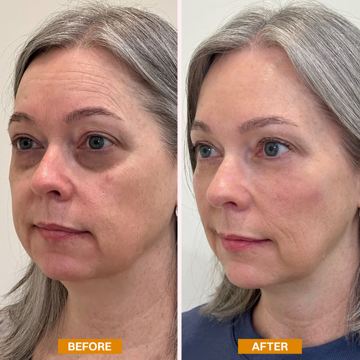 LIMETOW® Retinol Eyebag Cream