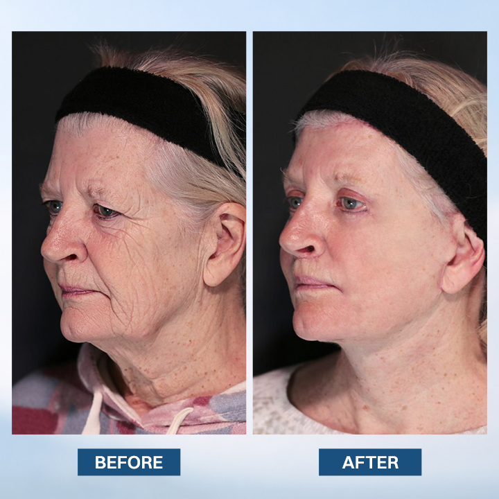 LIMETOW® Facelift Serum