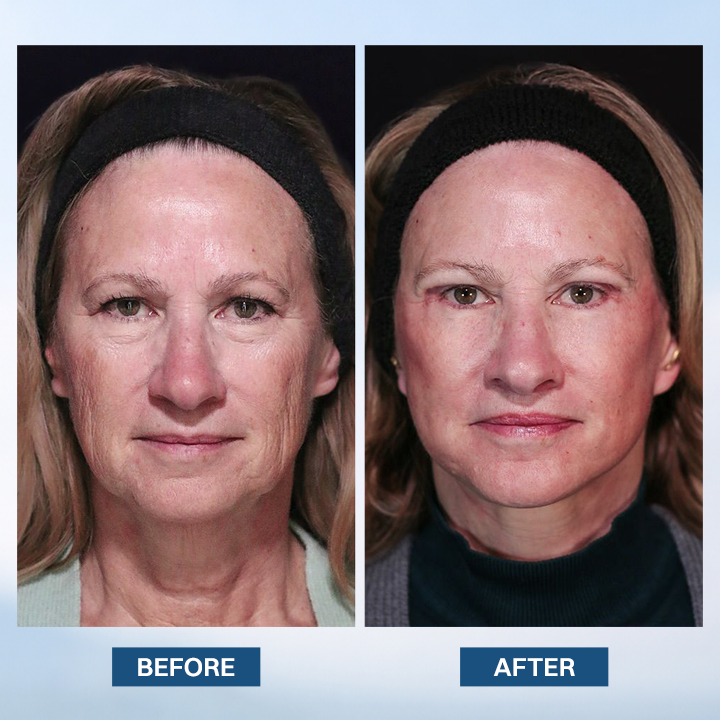 LIMETOW® Facelift Serum