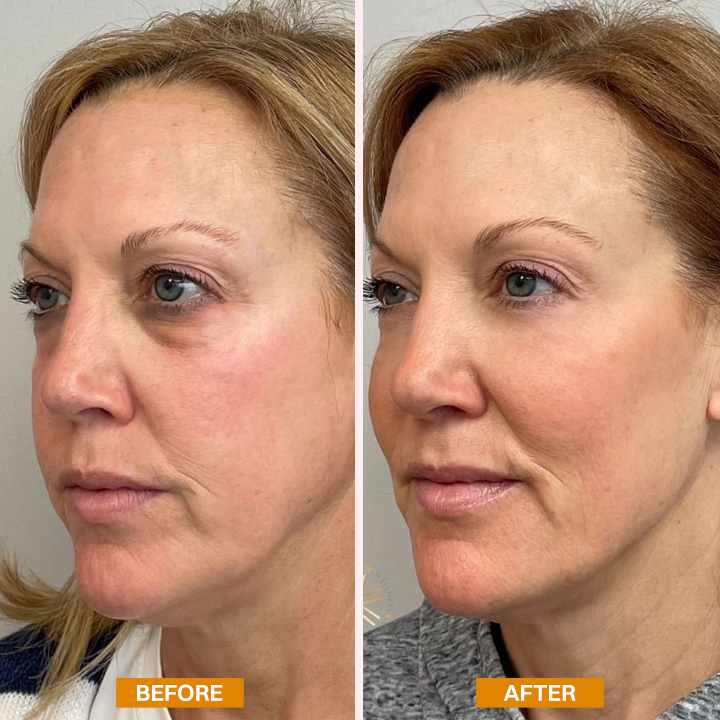 LIMETOW® Retinol Eyebag Cream