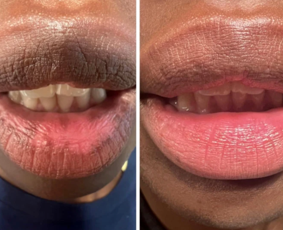 LIMETOW® Dark Lips Brightening Cream