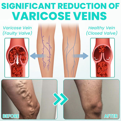 LIMETOW® LegResume Varicose Veins Patch