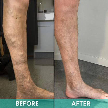 LIMETOW® LegResume Varicose Veins Patch