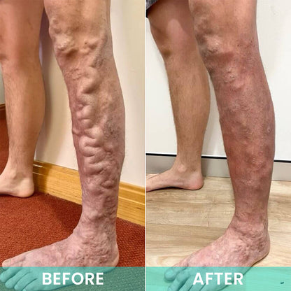LIMETOW® LegResume Varicose Veins Patch